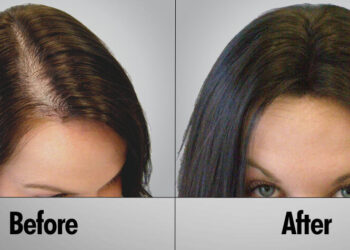 Hair Transplant